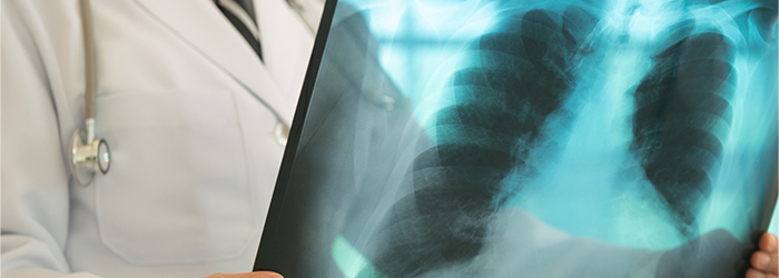 Lung Cancer Screening